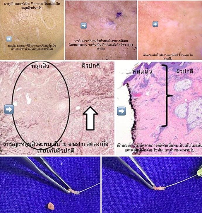 พังผืด Fibrosis ในหลุมสิวมีลักษณะอย่างไร ? พังผืด Fibrosis ในหลุมสิวมีลักษณะอย่างไร ?